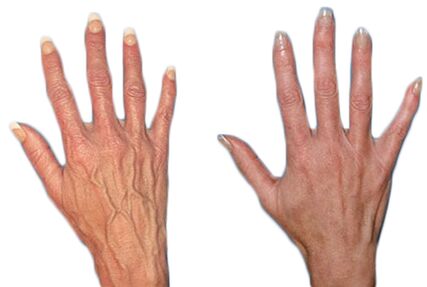 The effect of Neoveris for the treatment of varicose veins on the hands