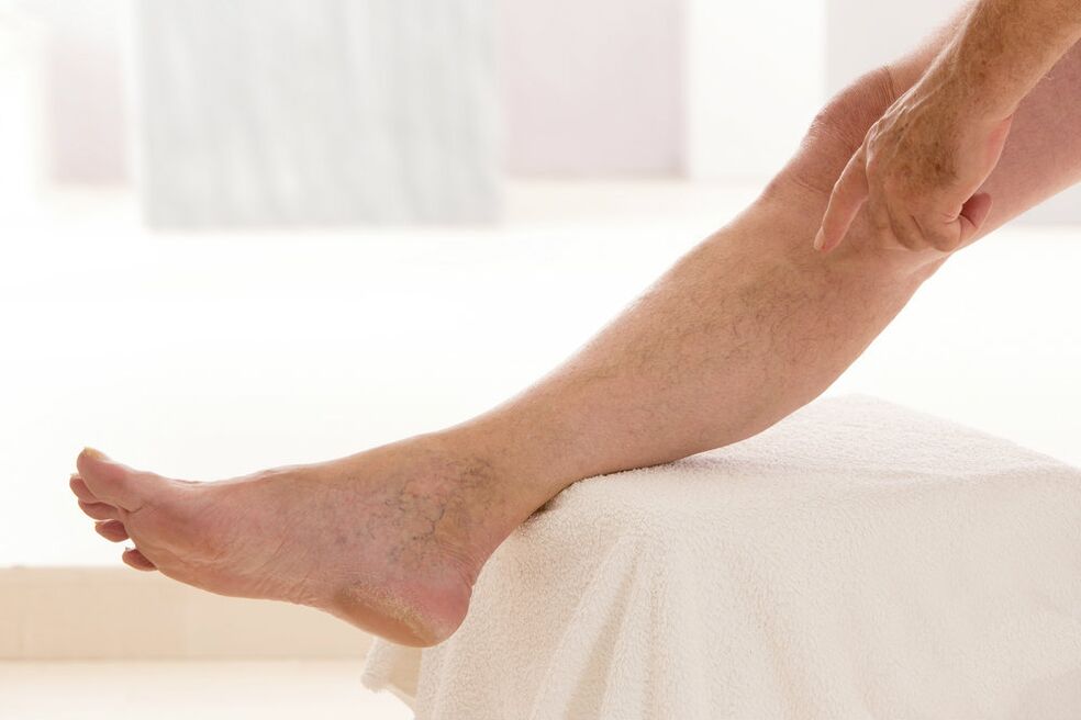 Varicose veins on their feet
